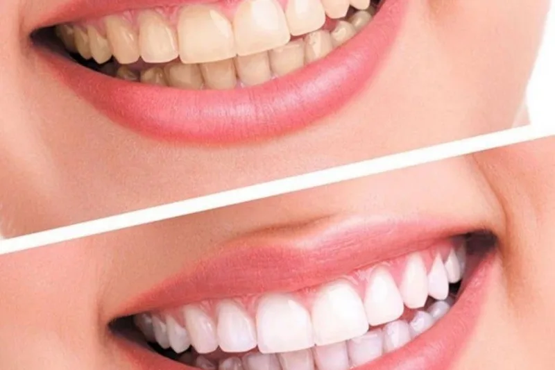 Blanqueamiento Dental