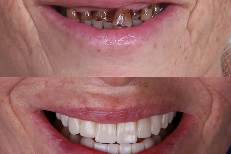Implantes Dentales